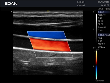 EDAN Acclarix LX25
