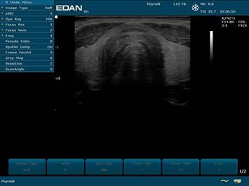 EDAN U2