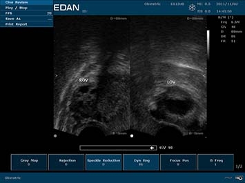 EDAN U50